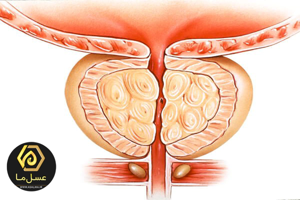 پروستات و مشکلات مرتبط ب