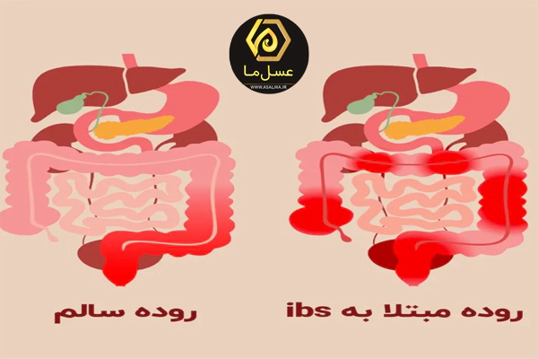 تسکین علائم سندروم روده تحریک‌پذیر (IBS) با عسل 