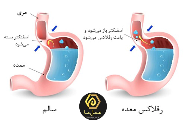 جلوگیری از ریفلاکس معده با عسل