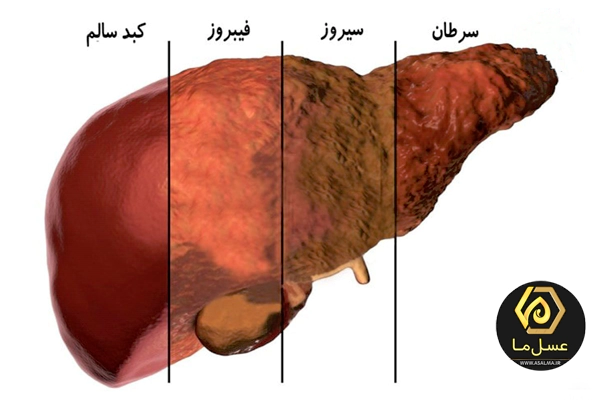 برای کبد چرب چی بخوریم