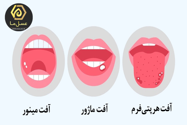 درمان آفت دهان با عسل